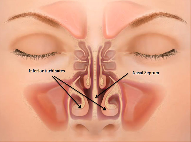 Nasal Fracture - Facial Trauma