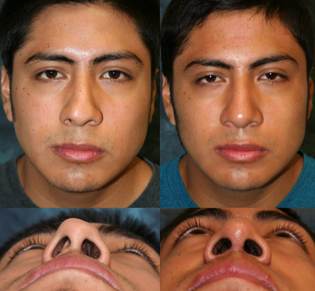 Nasal Fracture - Facial Trauma