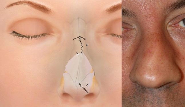 Nasal Fracture Facial Trauma