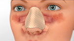 nasal fracture
