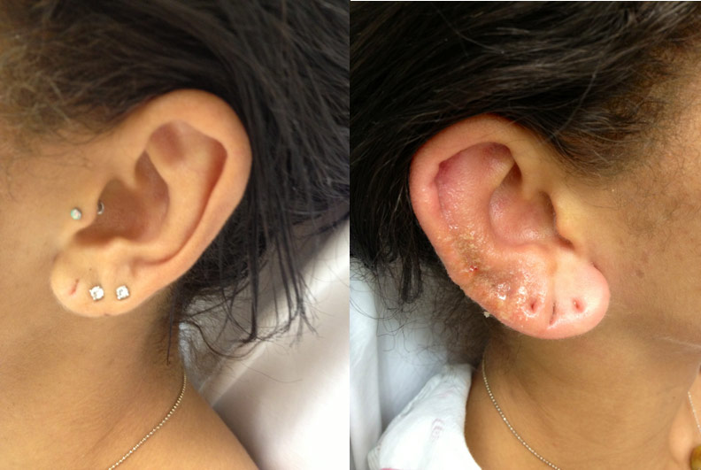 Figure: Perichondritis progressing to chondritis of the right ear (right). Patient’s unaffected left ear (left).